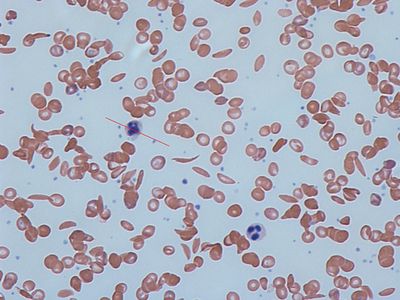 Sickle cell anemia